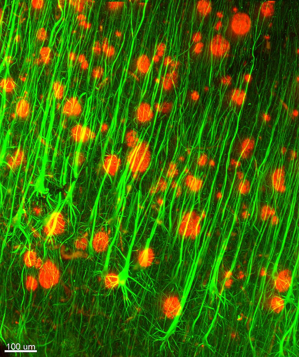 Pyramidceller (gröna) och amyloidplack (röda) i hjärnbarken hos en person som har gått bort i Alzheimers sjukdom. Pyramidceller (gröna) och amyloidplack (röda) i hjärnbarken hos en person som har gått bort i Alzheimers sjukdom.