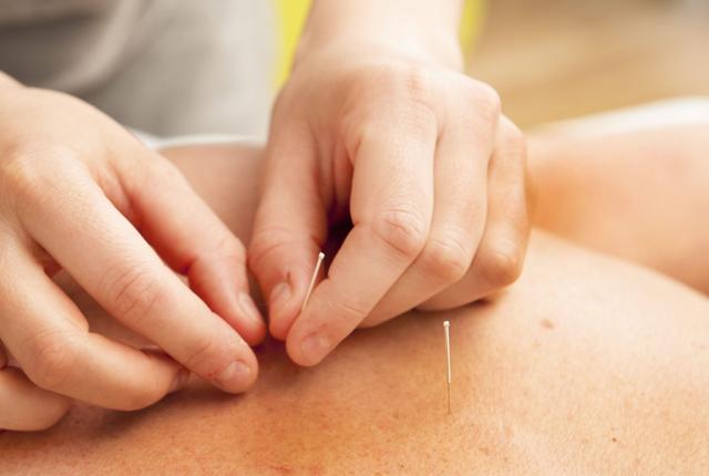 Akupunktur er en gammelkendt kinesisk behandlingsmetode - hos LOF kan man nu blive klogere på, hvordan det virker. Arkivfoto: Kurt Bering