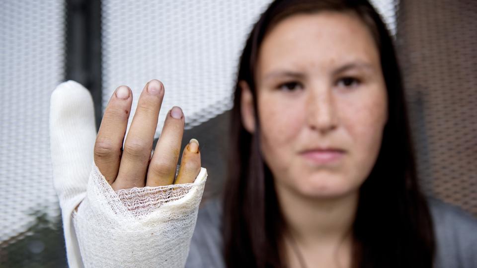 Annika Jørgensen brækkede to fingre og blev syet med i alt 15 sting i sin højre hånd. Foto: Henrik Bo <i>Foto: Henrik Bo</i>