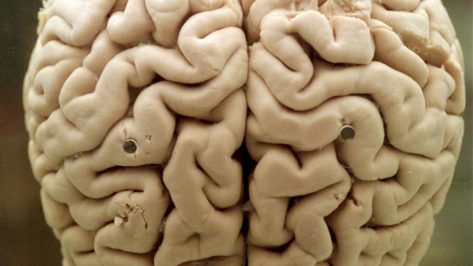 - Hypotesen er, at vi ved at blive bedre til at skabe og måle ændringer i hjernens plasticitet, fortæller professor Ole Kæseler Andersen blandt andet. Arkivfoto <i>NF</i>