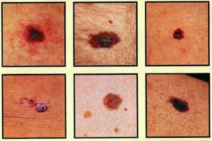 Kløende hudskader kan være tegn på kræft