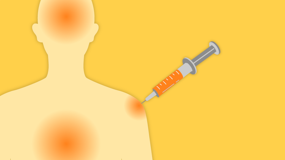 Lægemiddelstyrelsen er ved at drukne i indberetninger fra vaccinerede danskere, langt de fleste handler om helt almindelige og harmløse bivirkninger som feber og hovedpine. Grafik: Christian Made Hagelskjær