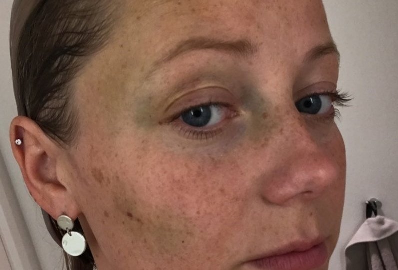 LA's spidskandidat i Aalborg blev slået ned men lader sig ikke slå ud. Privatfoto.