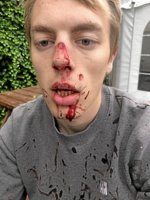 Asger brækkede næsen ved turistattraktion - nu har hans far låst stedet af med sønnens cykellås