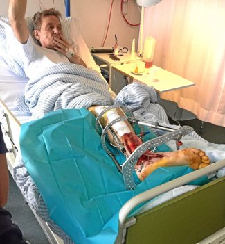 Steen Lykke Larsen var igennem en række operationer, hvor der blev fjernet dødt væv i fod og ben. I dag har han kroniske smerter i foden. Han kan kun gå korte ture - med stok. Privatfoto.