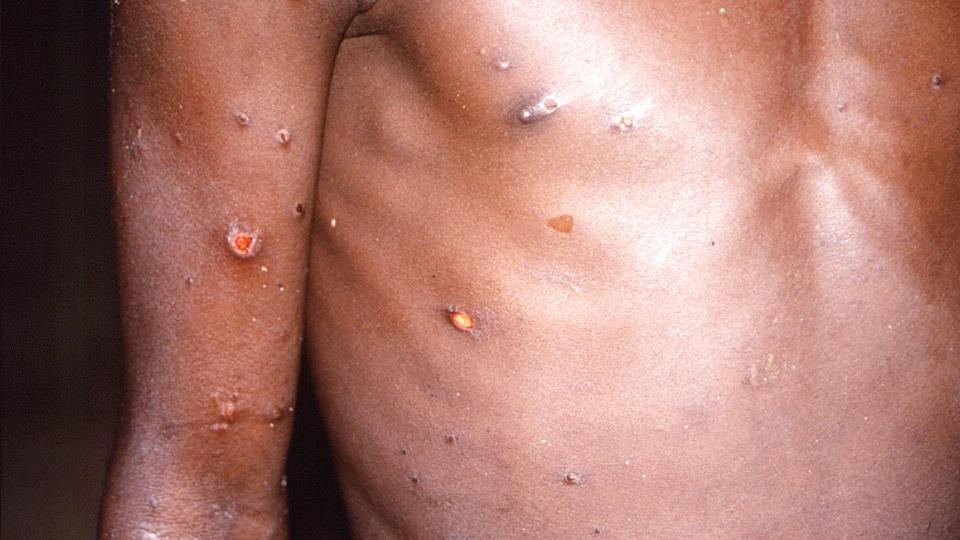 Mandag er det første tilfælde af abekopper registreret i Danmark. Symptomerne er blandt andet feber, kulderystelser og udslæt med blærer, der kan give sår. <i>Foto: Brian W.j. Mahy/Reuters</i>