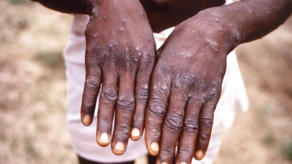 Sundhedsministeriet beskriver symptomerne på abekopper som blandt andet feber, kulderystelser og et udslæt med blærer, som kan give sår, når de heler. (Arkivfoto). <i>Cdc/Brian W.j. Mahy/Reuters</i>