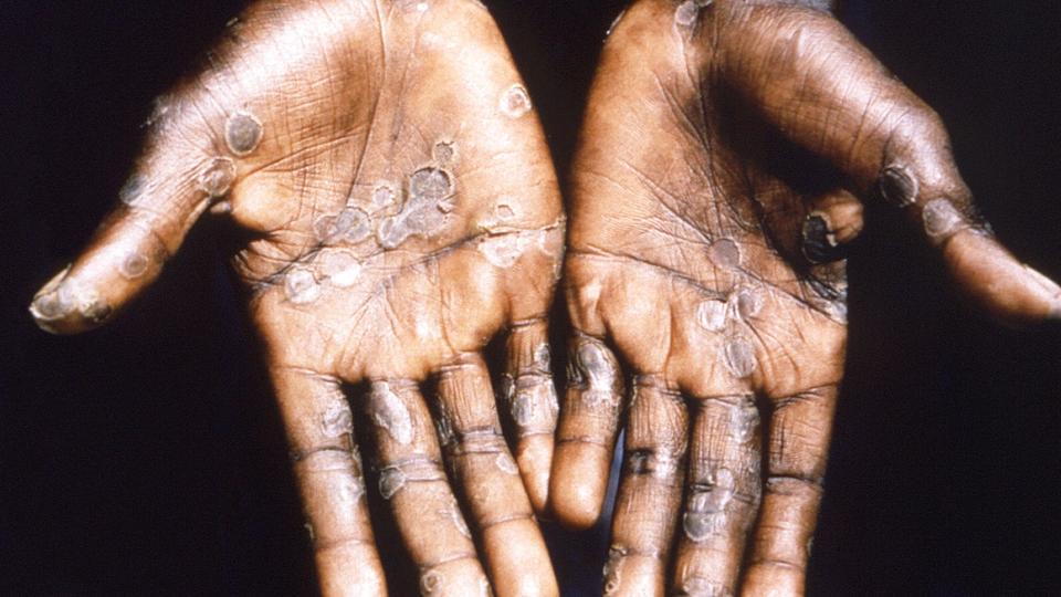 Abekopper er en virussygdom. Den kan blandt andet give feber og udslæt med hvide blærer. Udbruddet i Europa kan blive større over sommeren på grund af festivaler, advarer WHO tirsdag. (Arkivfoto). <i>Cdc/Reuters</i>