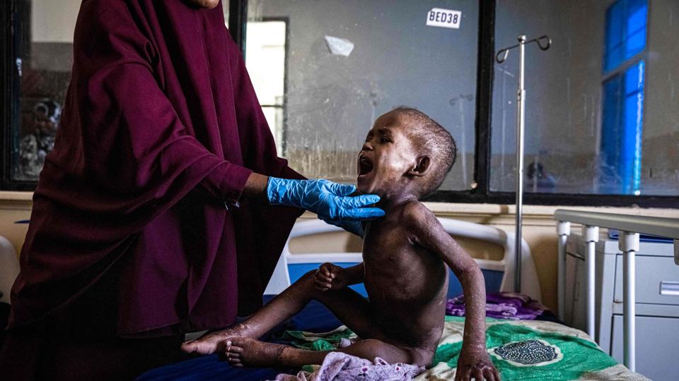 En underernæret dreng på 27 måneder undersøges på et hospital i Mogadishu, Somalias hovedstad. <i>Ed Ram/Ritzau Scanpix</i>
