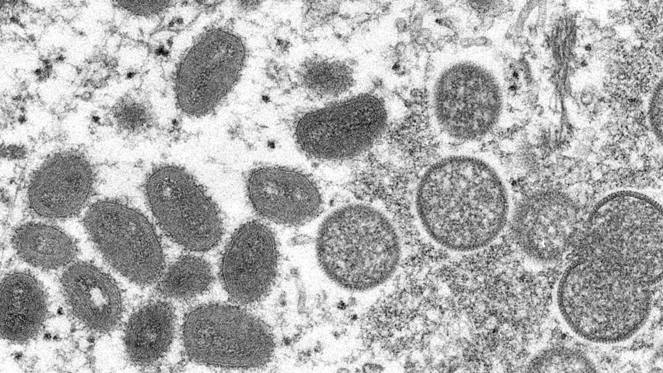 Abekopper er en virussygdom, der blandt andet kan give feber og udslæt med hvide blærer. (Arkivfoto). <i>Cynthia S. Goldsmith/Ritzau Scanpix</i>