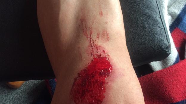 Henrik Skovmoses knæ efter cykelstyrtet i 2014. <i>Foto: Henrik Skovmose</i>