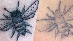 Overlæge med skarp kritik: Myndighederne gør ikke nok for at stoppe ulovlige tatovører