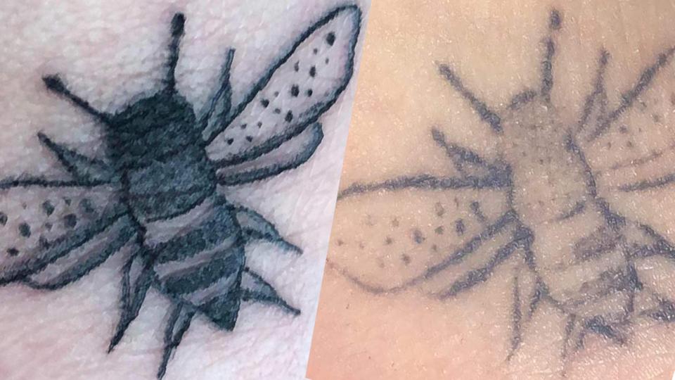 Scandinavian Art bliver ikke længere kun beskyldt for at aflyse planlagte sessioner, men også for dårlig kvalitet. Mathilde Johansens tatoverede bi faldt af efter få dage. <i>Privatfotos</i>