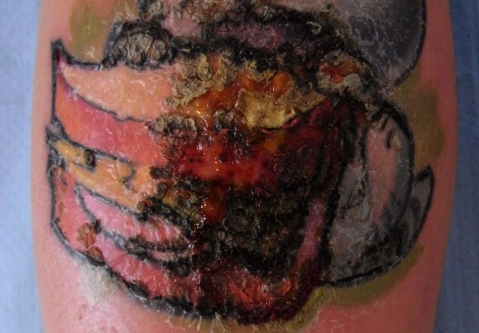 Er der ikke styr på hygiejne og sikkerhed, kan tatoveringskunder ende med en stafylokokinfektion, som vist på billedet. <i>Foto: Tatoveringsklinikken, dermatologisk afd. Bispebjerg Hospital</i>