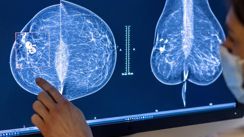 Flere kvinder kræver erstatning efter at de er blevet indkaldt for sent til screening for brystkræft. (Arkivfoto). <i>Michael Hanschke/Ritzau Scanpix</i>