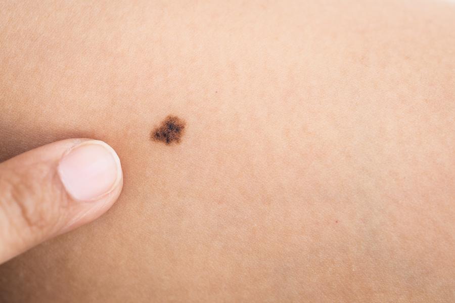 Forskarna testade om mikronålsplåster kan användas vid hudförändringar för att upptäcka hudcancer. Forskarna testade om mikronålsplåster kan användas vid hudförändringar för att upptäcka hudcancer.